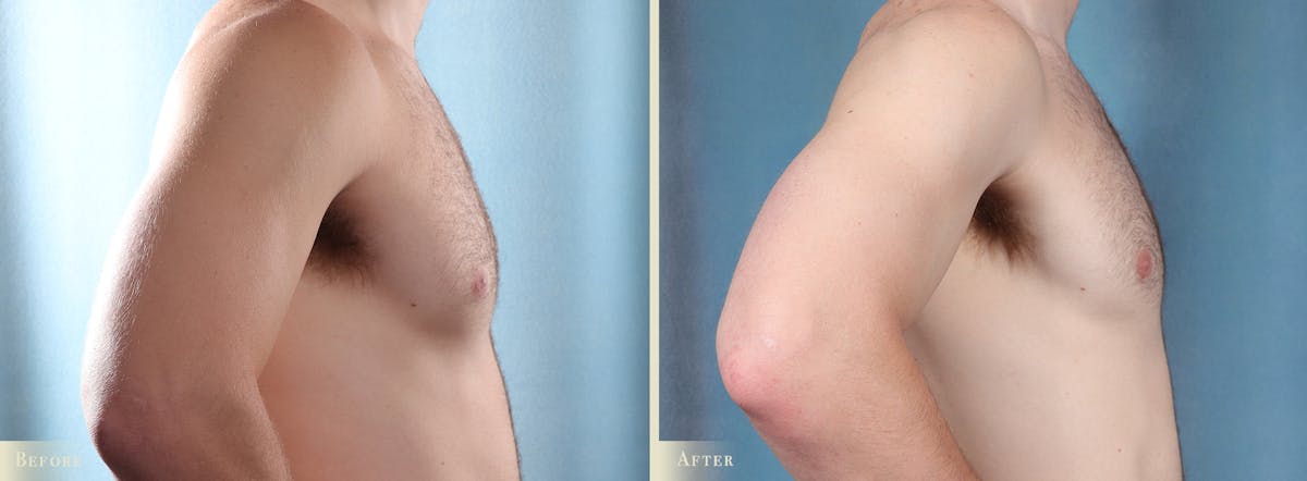 Male Breast Reduction (Gynecomastia) Before & After Gallery - Patient 200969 - Image 3