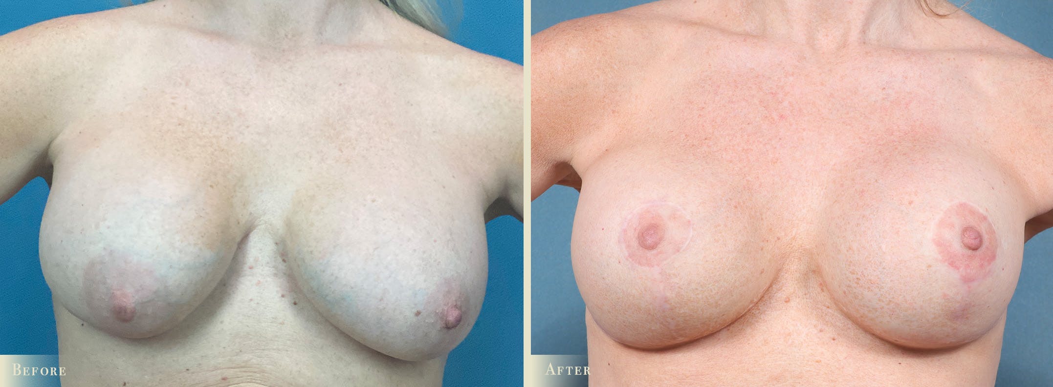 Breast Implant Revision/Replacement Before & After Gallery - Patient 225920 - Image 1