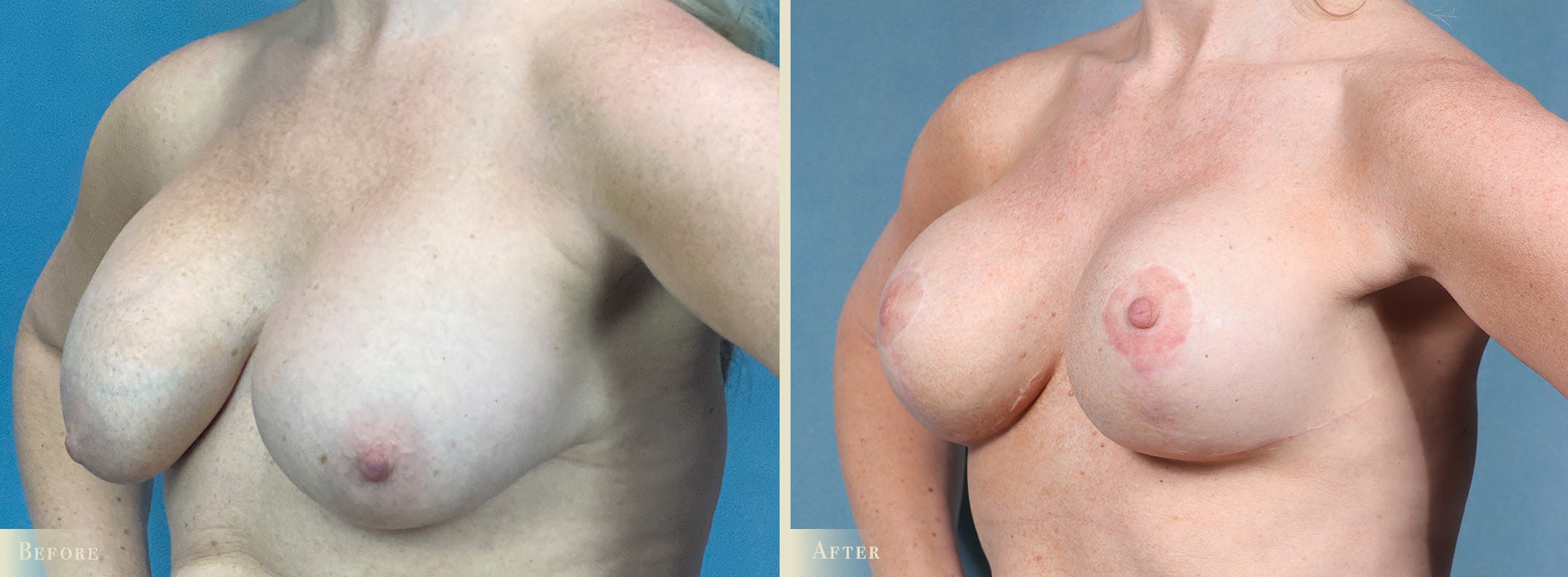 Breast Implant Revision/Replacement Before & After Gallery - Patient 225920 - Image 2