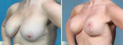 Breast Implant Revision/Replacement Before & After Gallery - Patient 225920 - Image 2