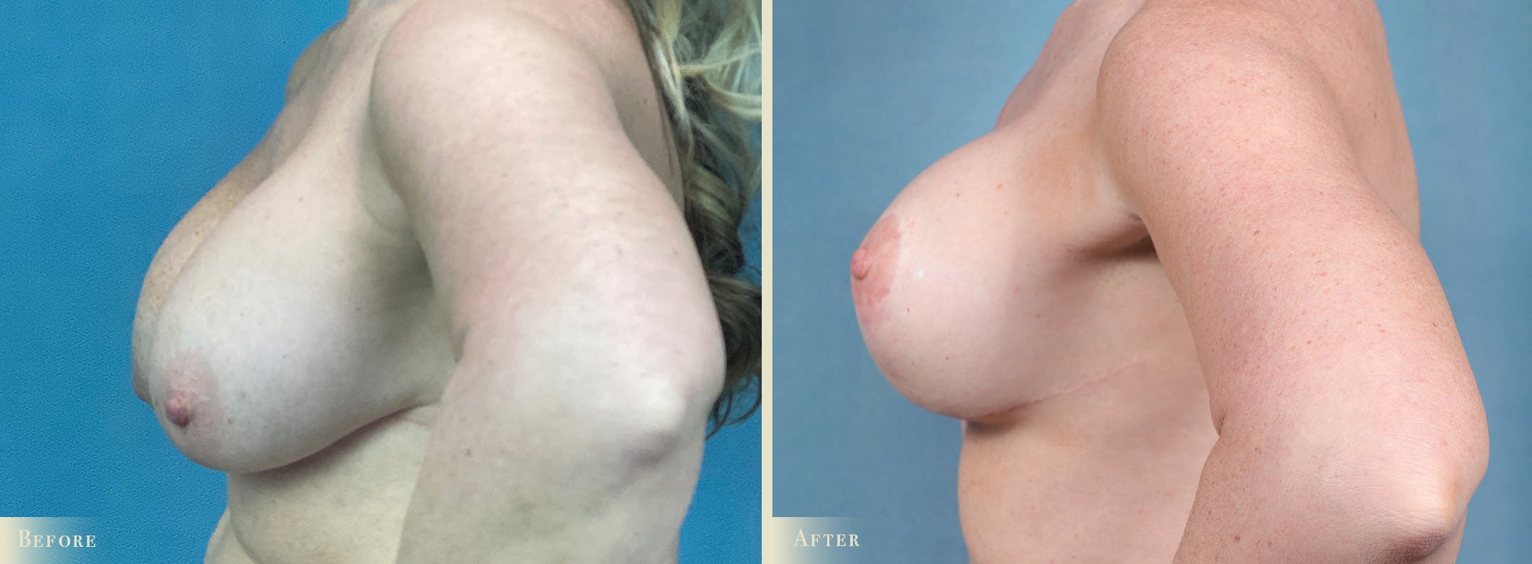 Breast Implant Revision/Replacement Before & After Gallery - Patient 225920 - Image 3