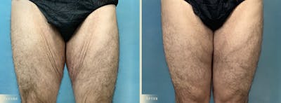 Thigh Lift Before & After Gallery - Patient 306946 - Image 1