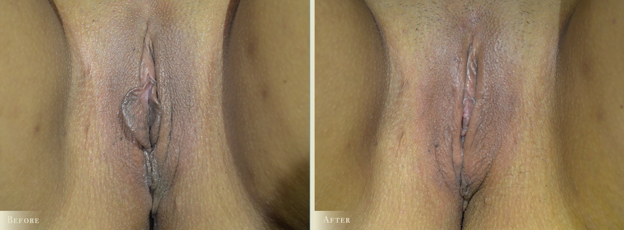 Labiaplasty Before & After Gallery - Patient 997596 - Image 1