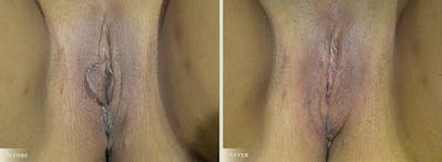 Labiaplasty Before & After Gallery - Patient 997596 - Image 1
