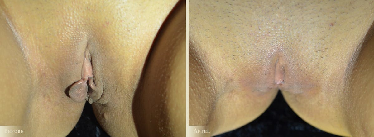 Labiaplasty Before & After Gallery - Patient 997596 - Image 2
