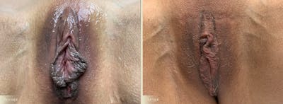 Labiaplasty Before & After Gallery - Patient 282935 - Image 1