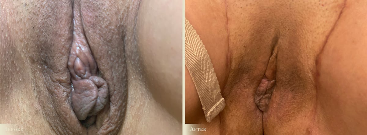 Labiaplasty Before & After Gallery - Patient 338541 - Image 1