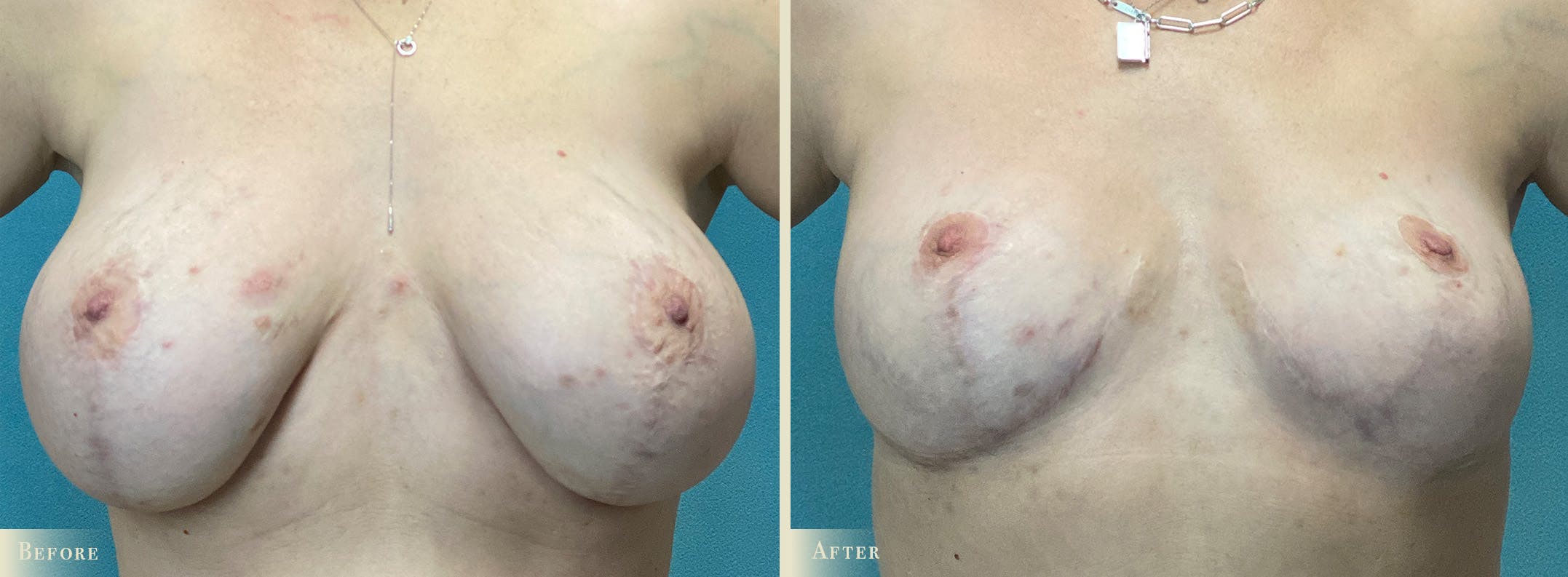 Explant with Lift Before & After Gallery - Patient 232665 - Image 1
