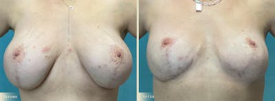 Explant with Lift Before & After Gallery - Patient 232665 - Image 1