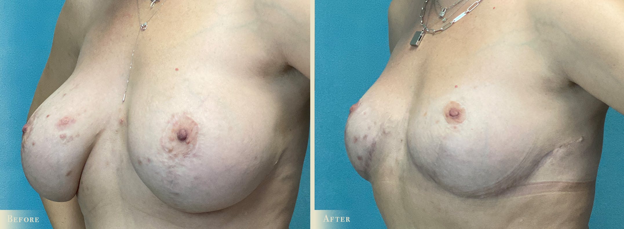 Explant with Lift Before & After Gallery - Patient 232665 - Image 2