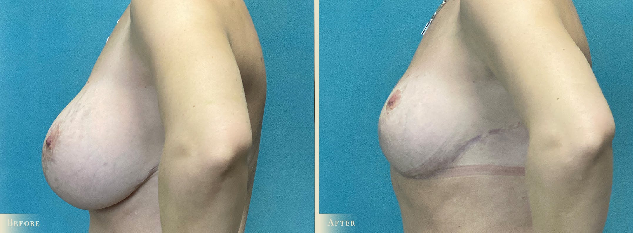Explant with Lift Before & After Gallery - Patient 232665 - Image 3