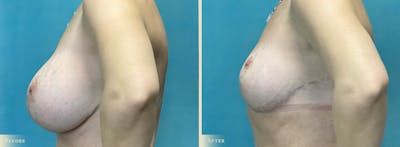 Explant with Lift Before & After Gallery - Patient 232665 - Image 3