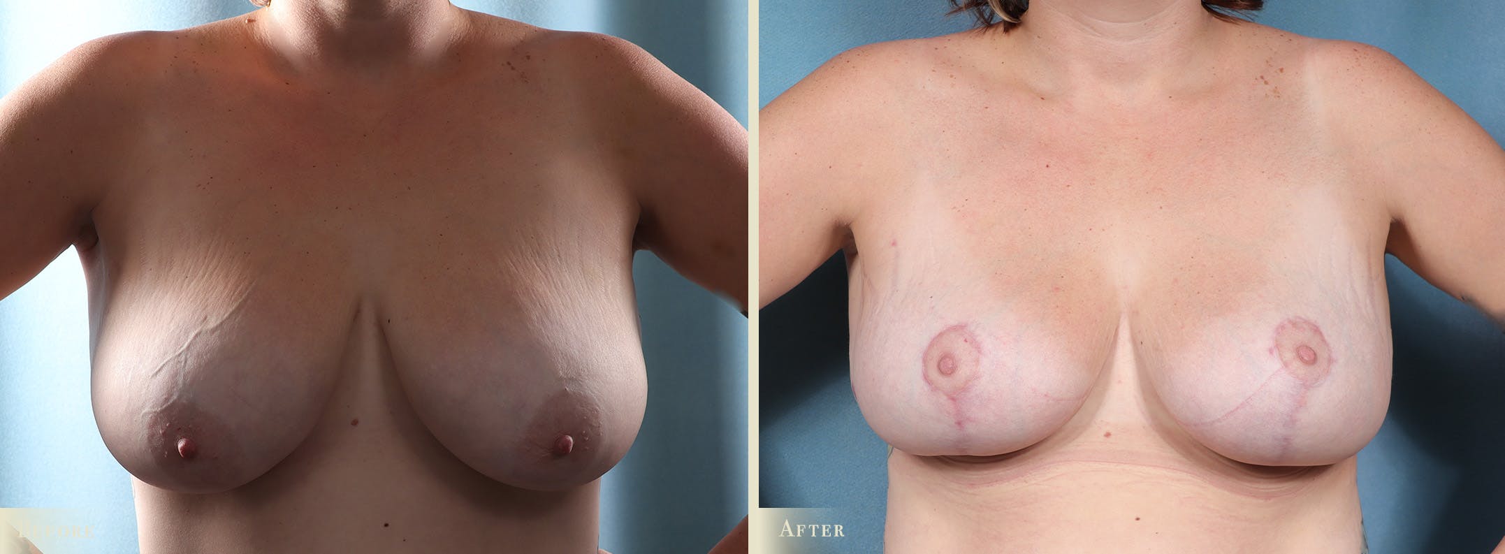 Breast Reduction Before & After Gallery - Patient 157907 - Image 1