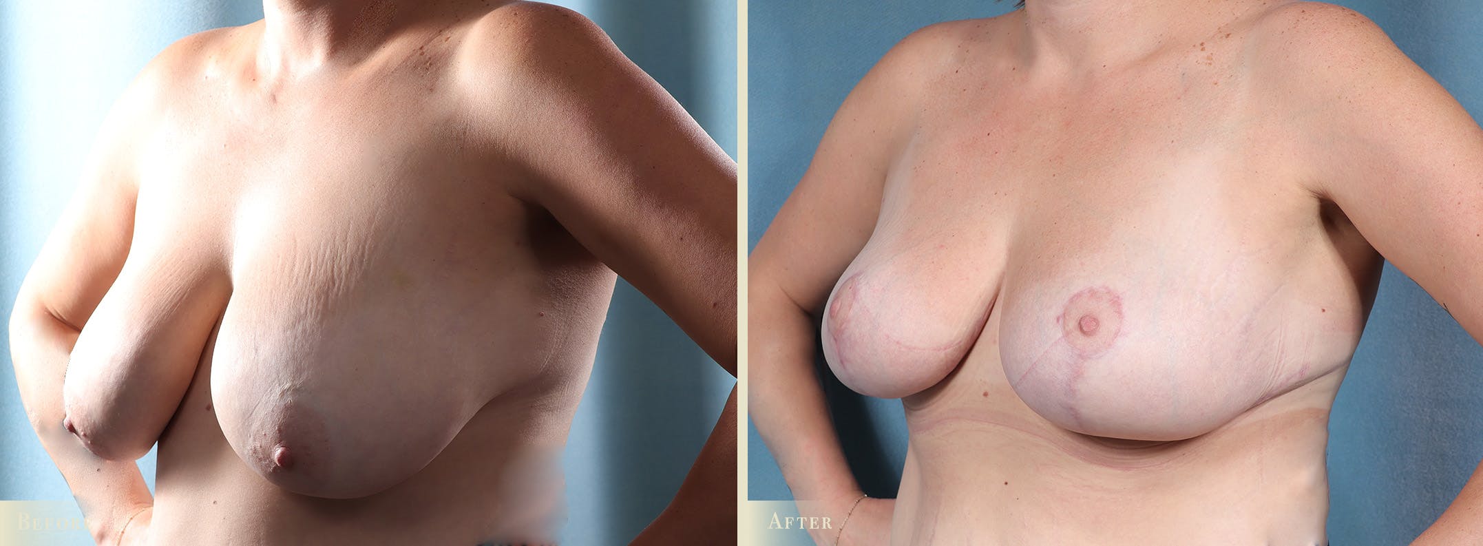 Breast Reduction Before & After Gallery - Patient 157907 - Image 2
