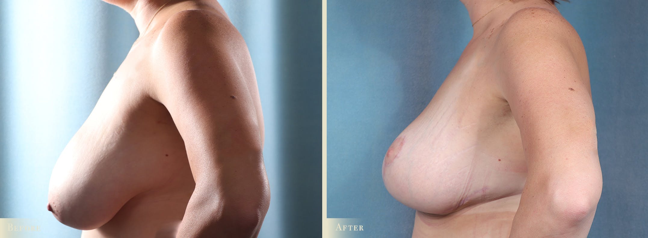 Breast Reduction Before & After Gallery - Patient 157907 - Image 3