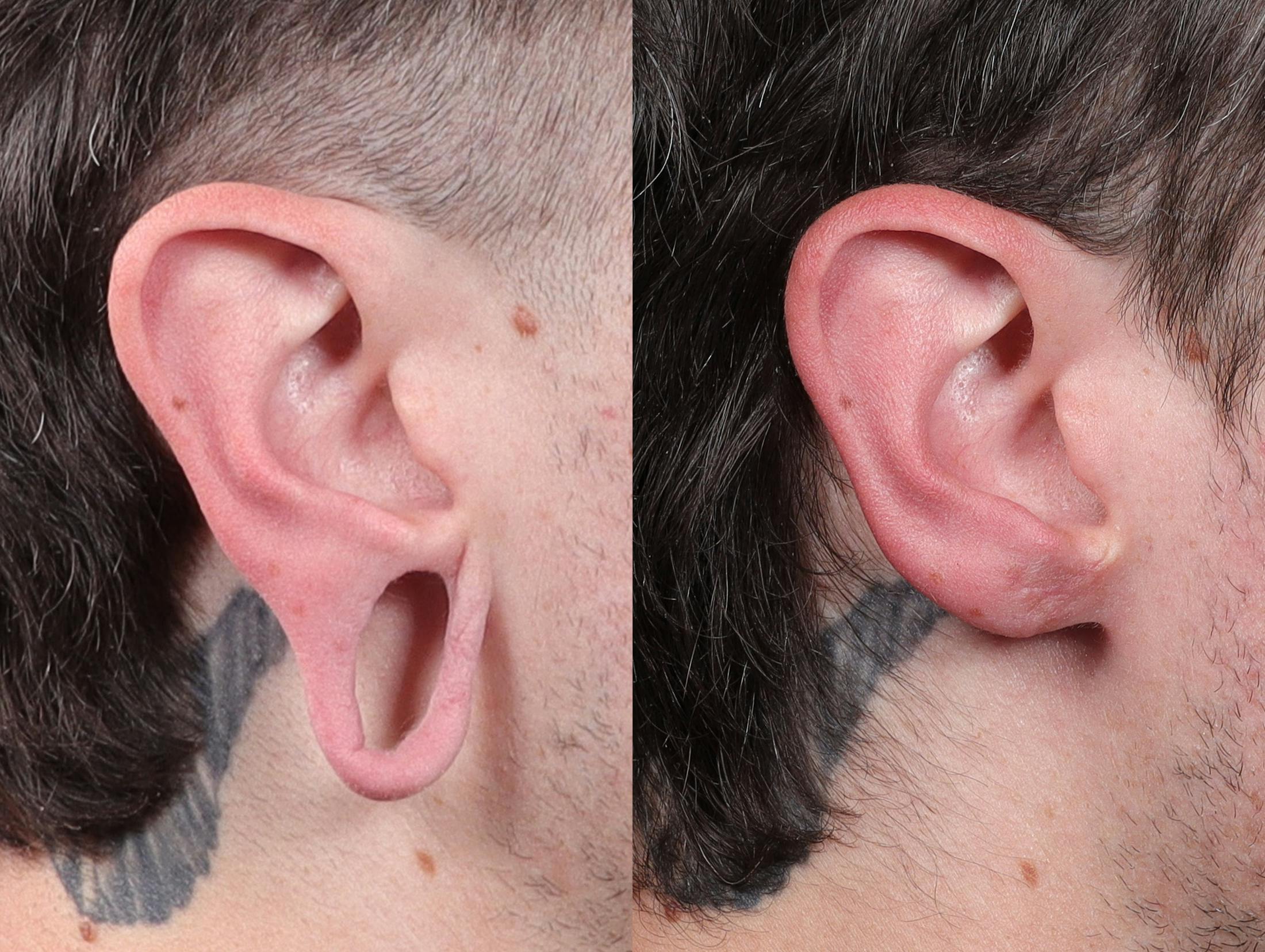 Earlobe Repair Before & After Gallery - Patient 116788 - Image 1