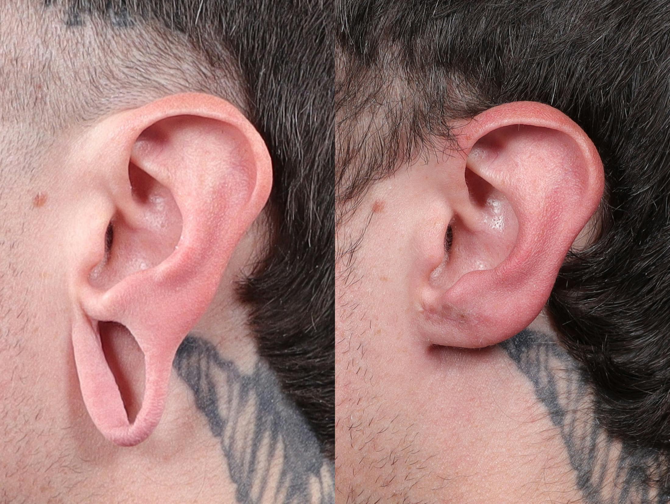 Earlobe Repair Before & After Gallery - Patient 116788 - Image 2