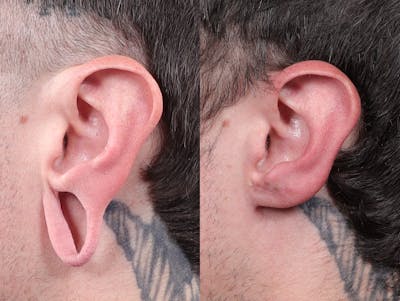 Earlobe Repair Before & After Gallery - Patient 116788 - Image 2