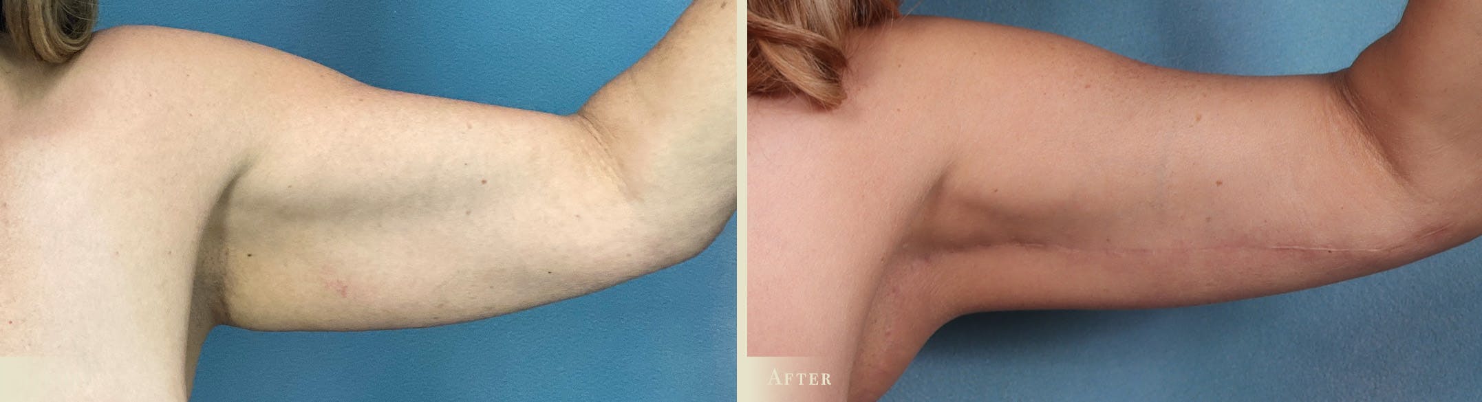 Arm Lift Before & After Gallery - Patient 129345 - Image 1