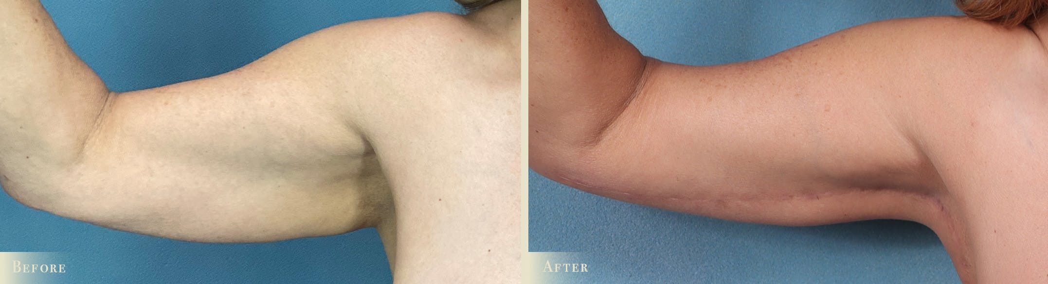 Arm Lift Before & After Gallery - Patient 129345 - Image 2