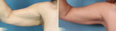 Arm Lift Before & After Gallery - Patient 129345 - Image 2