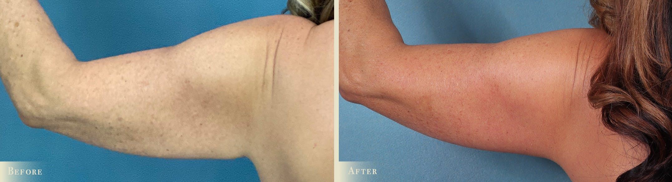 Arm Lift Before & After Gallery - Patient 129345 - Image 3