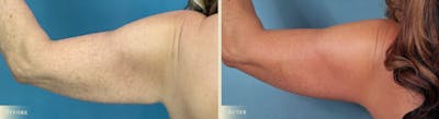 Arm Lift Before & After Gallery - Patient 129345 - Image 3