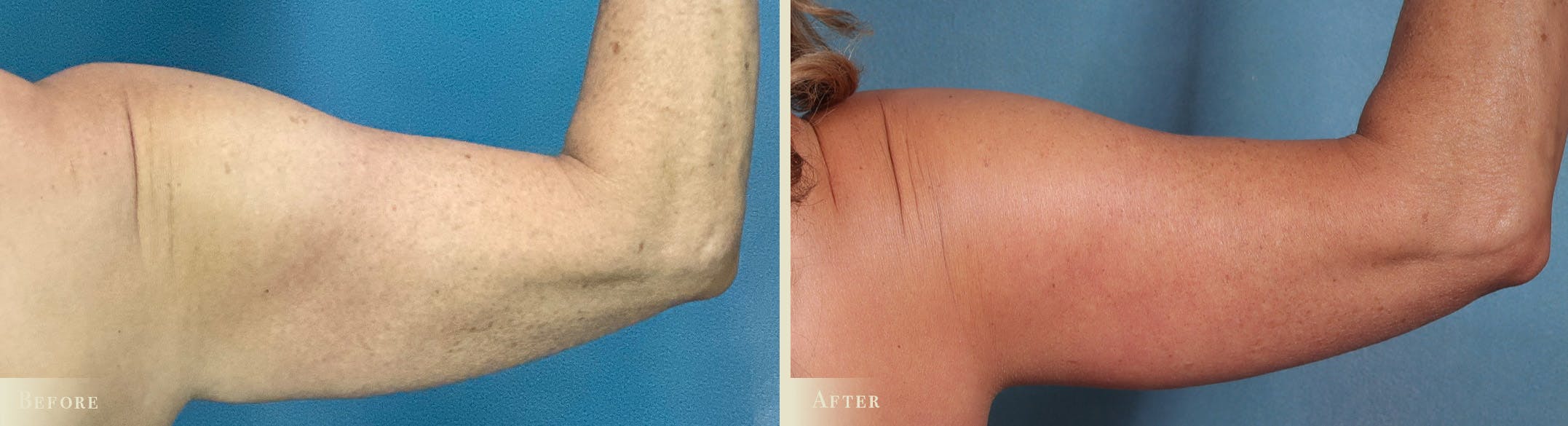 Arm Lift Before & After Gallery - Patient 129345 - Image 4