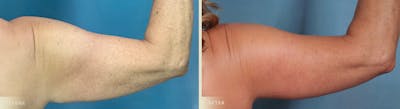 Arm Lift Before & After Gallery - Patient 129345 - Image 4
