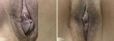 Labiaplasty Before & After Gallery - Patient 338541 - Image 1