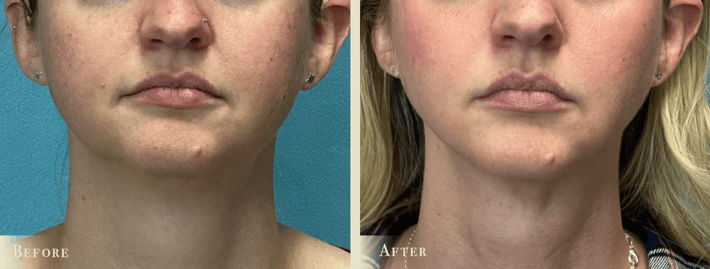 Neck Liposuction Before & After Gallery - Patient 731145 - Image 1