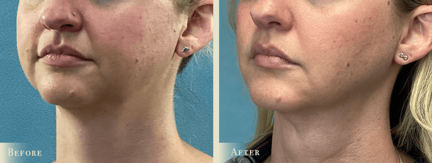 Neck Liposuction Before & After Gallery - Patient 731145 - Image 2