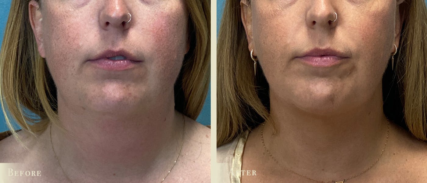 Neck Liposuction Before & After Gallery - Patient 195280 - Image 1