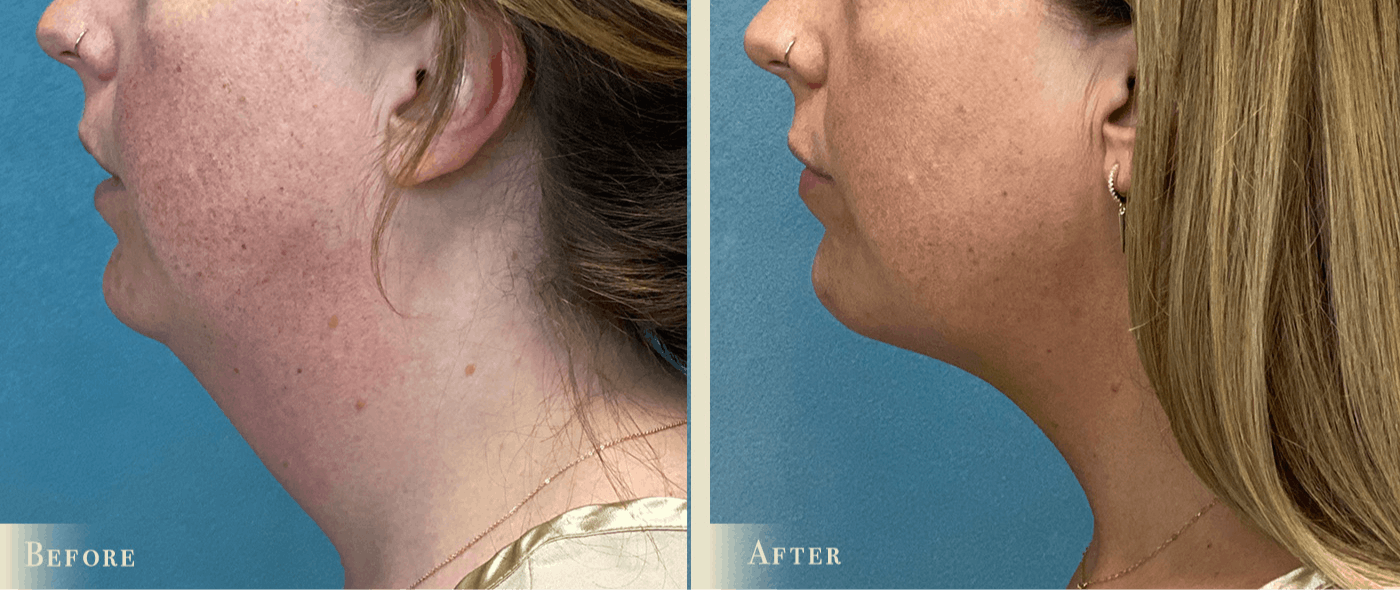 Neck Liposuction Before & After Gallery - Patient 195280 - Image 2