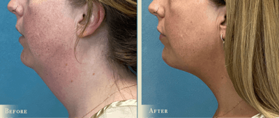 Neck Liposuction Before & After Gallery - Patient 195280 - Image 2