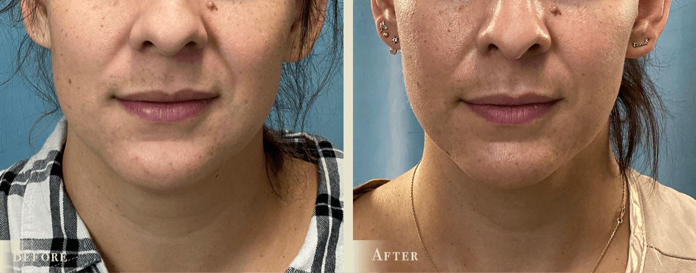 Neck Liposuction Before & After Gallery - Patient 177268 - Image 1