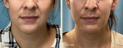 Neck Liposuction Before & After Gallery - Patient 177268 - Image 1