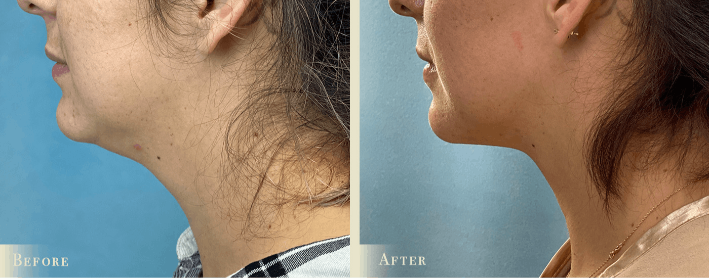 Neck Liposuction Before & After Gallery - Patient 177268 - Image 2
