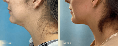 Neck Liposuction Before & After Gallery - Patient 177268 - Image 2