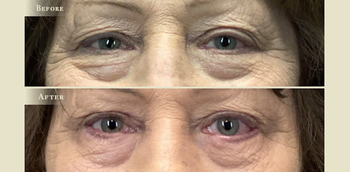 Eyelid Lift Before & After Gallery - Patient 696682 - Image 1