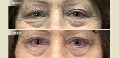 Eyelid Lift Before & After Gallery - Patient 696682 - Image 1