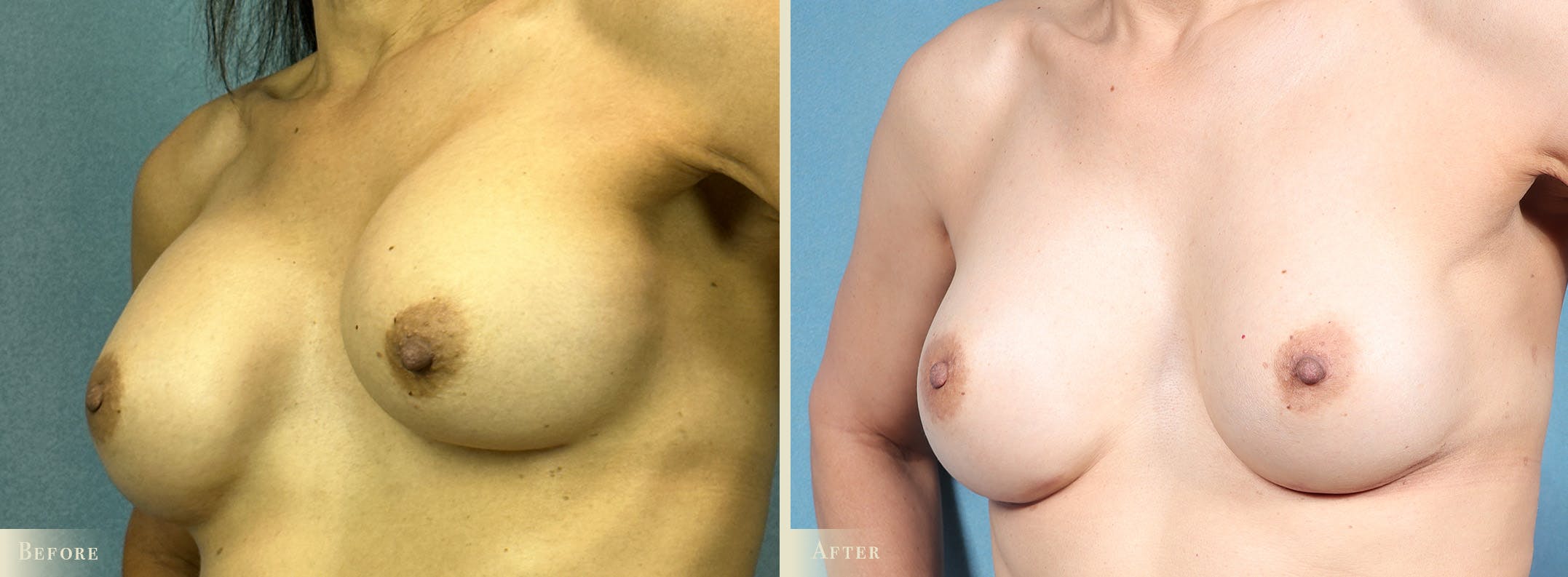 Breast Implant Revision/Replacement Before & After Gallery - Patient 188199 - Image 2