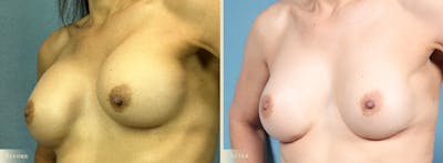 Breast Implant Revision/Replacement Before & After Gallery - Patient 188199 - Image 2