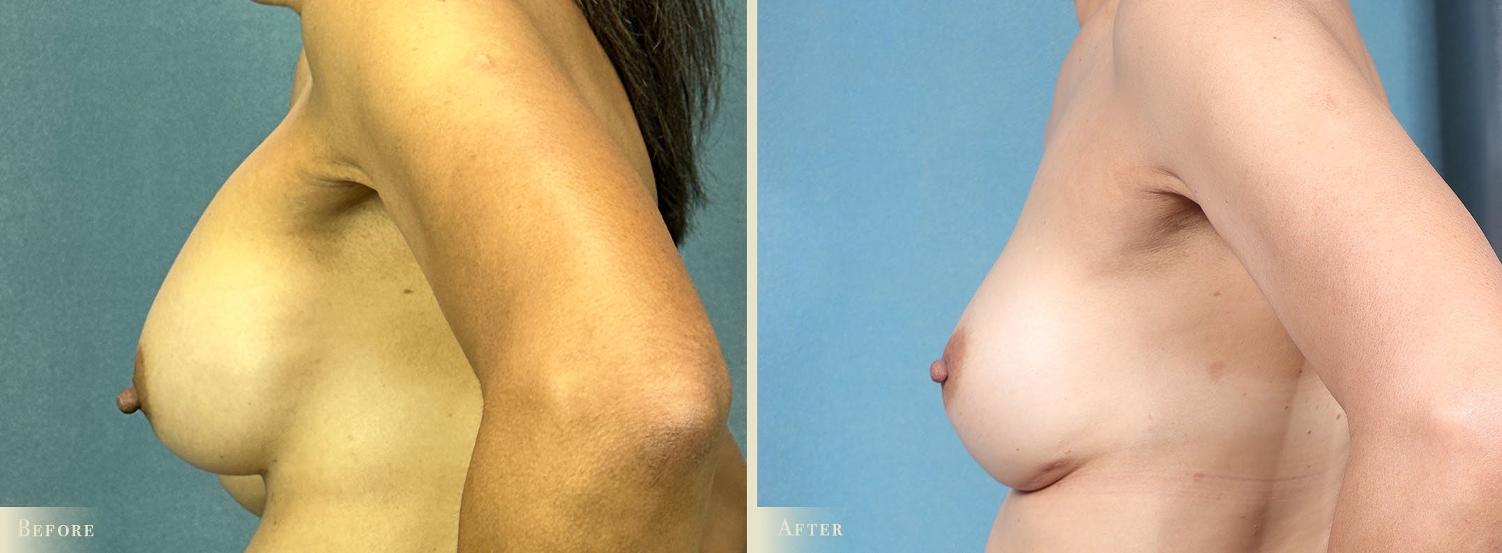Breast Implant Revision/Replacement Before & After Gallery - Patient 188199 - Image 3