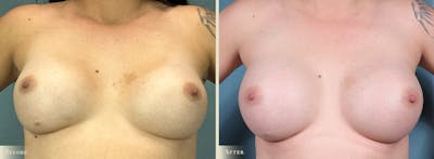 Breast Implant Revision/Replacement Before & After Gallery - Patient 368151 - Image 1