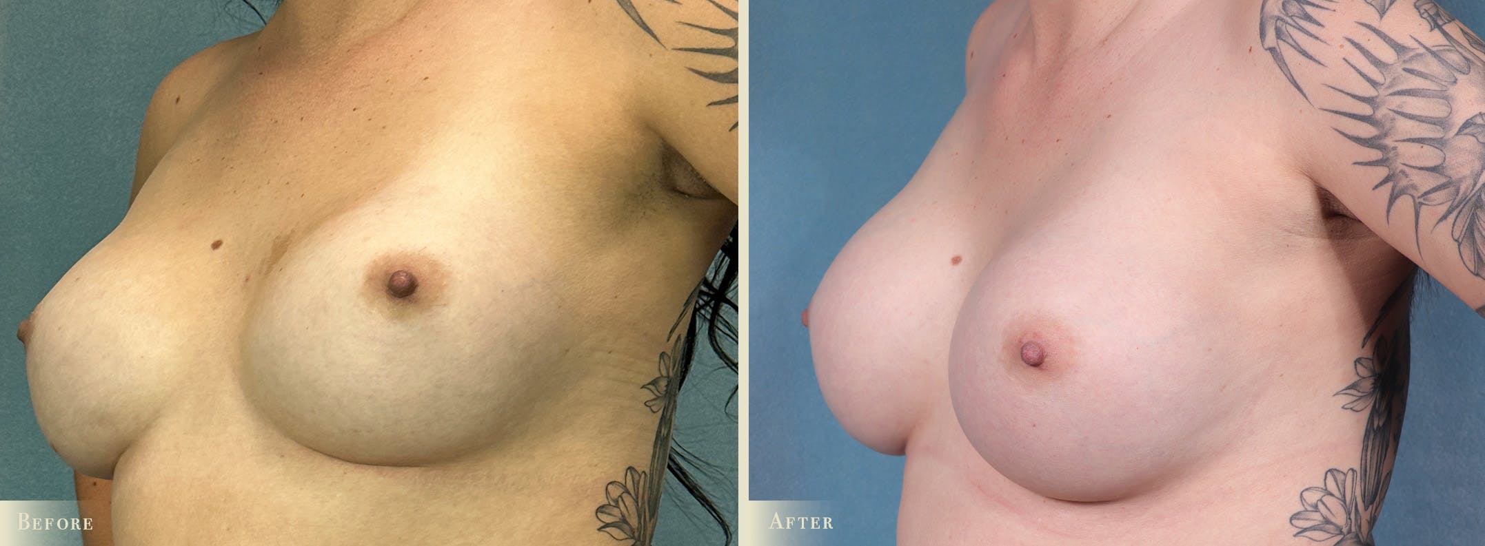 Breast Implant Revision/Replacement Before & After Gallery - Patient 368151 - Image 2