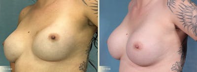 Breast Implant Revision/Replacement Before & After Gallery - Patient 368151 - Image 2