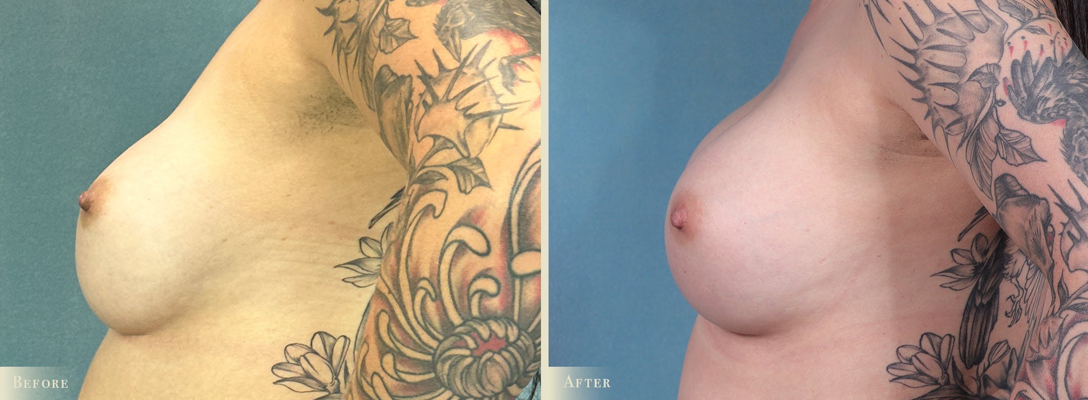 Breast Implant Revision/Replacement Before & After Gallery - Patient 368151 - Image 3