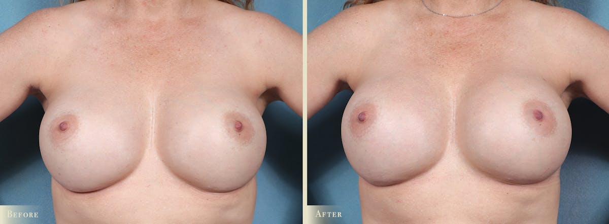 Breast Implant Revision/Replacement Before & After Gallery - Patient 972168 - Image 1