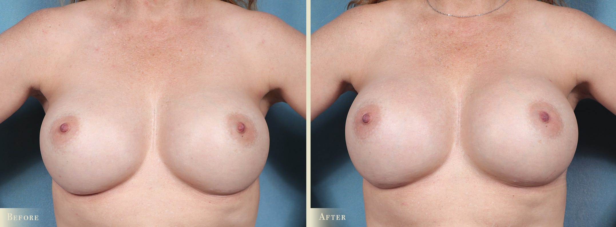 Breast Implant Revision/Replacement Before & After Gallery - Patient 972168 - Image 1